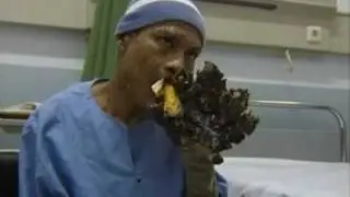 Human Treeman stops turning into a tree
