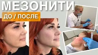 МЕЗОНИТИ ДО и ПОСЛЕ | Ставим Нити COG, профилактика старения лица 