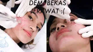 VAMPIRE FACIAL? SOLUSI BOPENG BEKAS JERAWAT! Nadya Aqilla