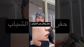 حفر واثار حب الشباب 👌