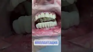 Удалили 10 зубов и поставили временные на All on 6. Removed 10 teeth and put temporary on All on 6.