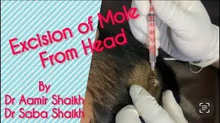 Mole excision from head by Dr Aamir Shaikh Dr Saba Shaikh #mole #cauterymachine #skincare