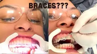 DID I NEED BRACES? Come with me on my journey!