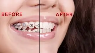 How to Remove Teeth Brace I Adobe Photoshop I