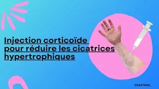 Injection corticoïde pour réduire les cicatrices hypertrophiques// Ftm trans français // CRAZYDEN