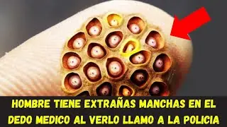 Hombre Tiene Extrañas Manchas Redondas En El Dedo, Cuando Los Médicos Las Ven, Llaman A La Policía.