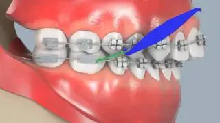How to put on Class II Elastics