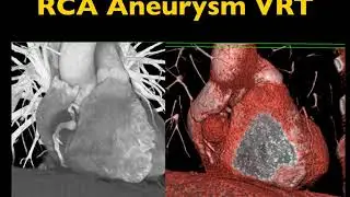 Getting to the Heart of Imaging: Coronary Artery CTA Part 2