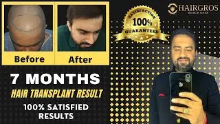 Hairgros Hair Transplant Result | 7 Months Result | Hairgros Mahipalpur |Bahadurgarh | Hisar