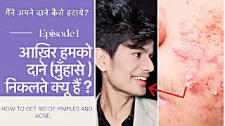 आख़िर हमारे चेहरे पर दाने (मुँहासे ) क्यू निकलते हैं ।HOW TO GET RID OF PIMPLE AND ANCE 1st episode