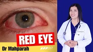 |Eye Flu/Red Eye/Viral Conjunctivitis| Symptoms,Preventions,Cure,Myths Answered 🔥 #health #doctor