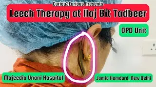 Leech Therapy at Ilaj Bit Tadbeer OPD Unit (Unani Regimenal Therapy) at Majeedia Unani Hospital, C2F