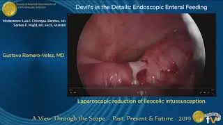 Laparoscopic reduction of ileocolic intussusception