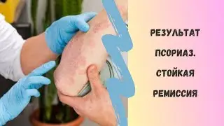 ПСОРИАЗ. СТОЙКАЯ РЕМИССИЯ