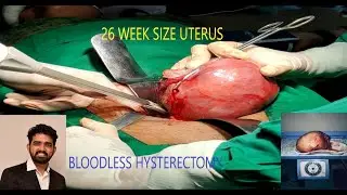 TOTAL ABDOMINAL HYSTERECTOMY 26 WEEK SIZE ADENOMYOTIC UTERUS USING LIGASURE