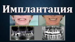 Секреты Стоматологии - Глава 6. Имплантация