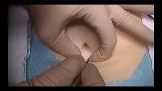 Open Hasson abdominal entry│Safe Laparoscopy