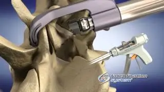 The FacetGun Max Facet Fixation System