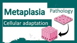 Topic: Metaplasia #pathology #residency #mbbs