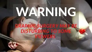 ACTUAL Cavitation Surgery - Removing Bacterial Infection of the Mouth