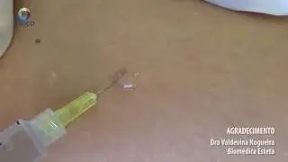 Peim - Procedimento Estético Injetável em Microvasos