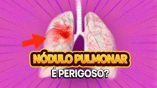 Descobri um Nódulo no Pulmão: Isso é Perigoso?