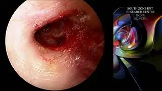 SHEES TYPE 1 TYMPANOPLASTY  ANTERIOR CANAL WALL BULGE