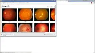 Optic Disc Localization (Retinal Image Processing) - MATLAB Code Implementation