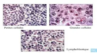 Virus et Lymphomes partie 04: diagnostic histologique des lymphomes