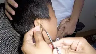Foreign Body Stuck in Boy's Ear | Gotta Remove It!