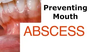 Preventing Mouth Abscess