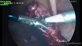 Внематочная Беременность ,трубадаги хомила