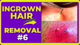 Ingrown hair removal videos [Compilations #6] #RemovalHair #ingrownhair #내성발톱  #ingrownhairShorts