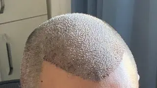 Муж сделал ТРАНСПЛАНТАЦИЮ ВОЛОС 🤯первые 2 дня и ПРОЦЕСС КАК ПРОИСХОДИЛО 🫣