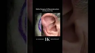 Mohs Skin Cancer Surgery & Scar Revision of Ear | Dr. Khorasani | NYC