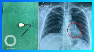 Jarum pentul tertelan saat wanita ini sedang merapikan hijab - TomoNews