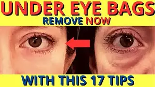 How to ELIMINATE Under Eye Bags NATURALLY