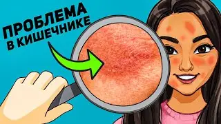 Проблемы с кожей? Проверь кишечник! / Осложнения Крона и колита