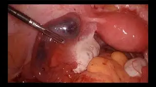 Tubal Ectopic Pregnancy │ Safe Laparoscopy