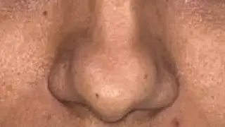 Bulbous Nose- Rhinopalsty, a classical Tip plasty surgical steps