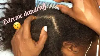 ASMR Scratching dandruff off scalp // Satisfying dandruff removal // No talking 😴