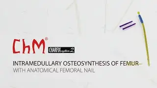 Intramedullary osteosynthesis of femur with CHARFIX2 anatomical femoral nail