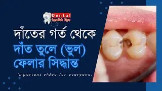 দাঁতের গর্ত || Tooth cavities @DentalHealthTips