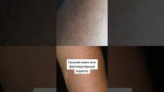 Что делать, если есть гусиная кожа?