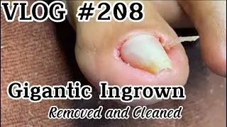 VLOG 208 Satisfying and Relaxing Pedicure: Removing all the Dead Skin and Ingrown #ingrownremoval