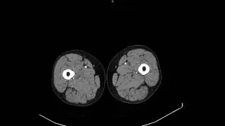 Computed tomography of the lower extremity vessels with intravenous bolus contrast