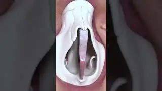 Making a crooked and deviated nose straight