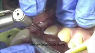 SINGLE UPPER CENTRAL INCISOR -One piece implant placement by FLAP METHOD