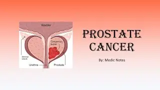Prostate cancer - symptoms, investigations, Gleason scoring, treatment