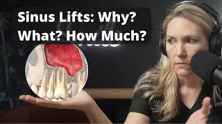 Sinus Lifts: What Are They And Why Would I need One?